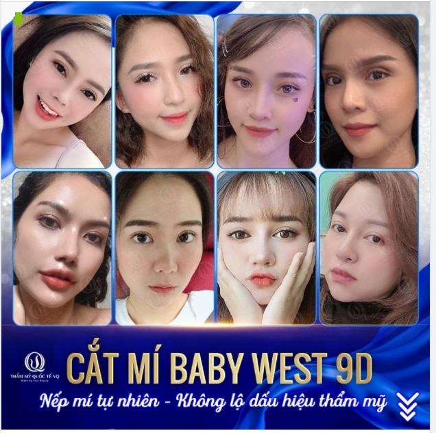 ​​​​​​​ Cắt mí Baby West 9D sẽ mang lại sự thay đổi lớn cho đôi mắt, khuôn mặt cũng như thần thái.