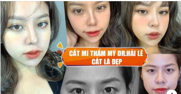 Cắt mí có đau không? Cắt mí bao lâu thì hồi phục và đẹp tự nhiên....