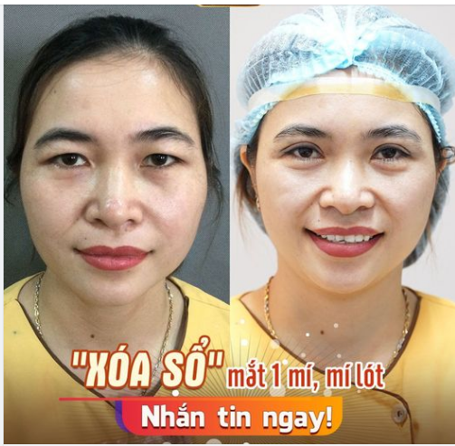 Cắt mí đau lắm, lại nhìn "giả trân", tốn tiền, mất thời gian mà lại không đẹp. KHÔNG HỀ NHA!