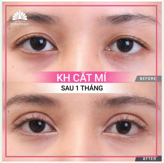 CẮT MÍ EYES REFESH: VẪN LÀ BẠN NHƯNG PHIÊN BẢN HOÀN HẢO HƠN