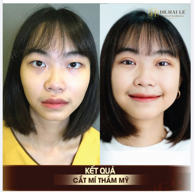 CẮT MÍ MANI OPEN DEEP 5D - BAO LÂU THÌ LÀNH VÀ ĐẸP TỰ NHIÊN?