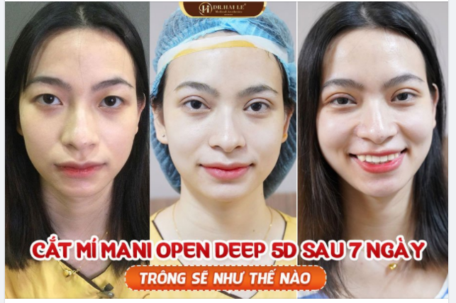 CẮT MÍ MANI OPEN DEEP 5D - ĐÔI MẮT ĐẸP THU HÚT MỌI ÁNH NHÌN.!!