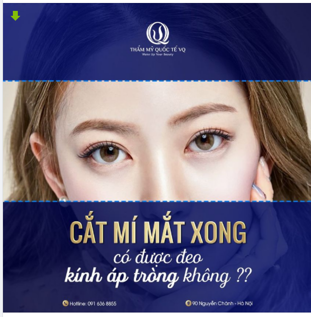 Cắt mí mắt xong có được đeo kính áp tròng không ??