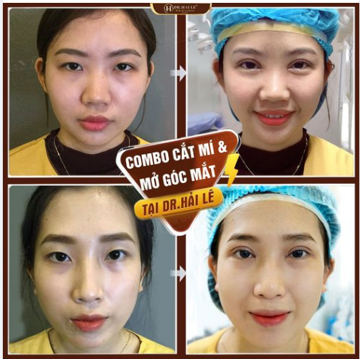 CẮT MÍ & MỞ GÓC MẮT - Sự lựa chọn hoàn hảo cho đôi mắt đẹp như ý.!!