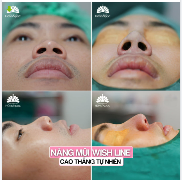 CHÀO NGÀY MỚI VỚI 1 CA NÂNG MŨI WISH LINE