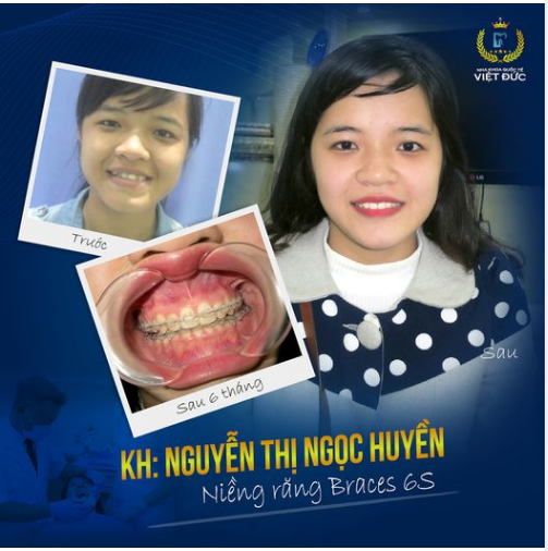 Chỉ 18 tháng niềng răng Ngọc Huyền đã trở thành phiên bản hoàn hảo của chính mình khi nụ cười thay đổi rõ rệt, ngoại hình "lên hương".