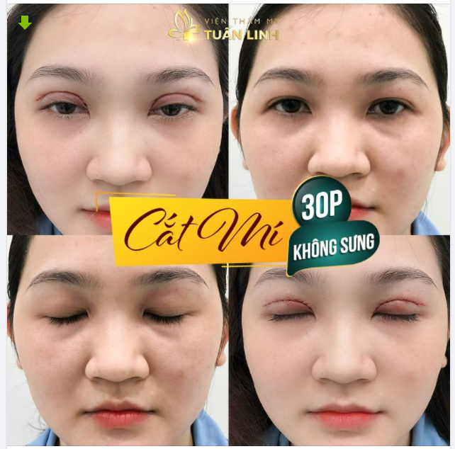 CHỈ 30 PHÚT - CÓ NGAY MẮT XINH - ĐẸP CHUẨN AN TOÀN