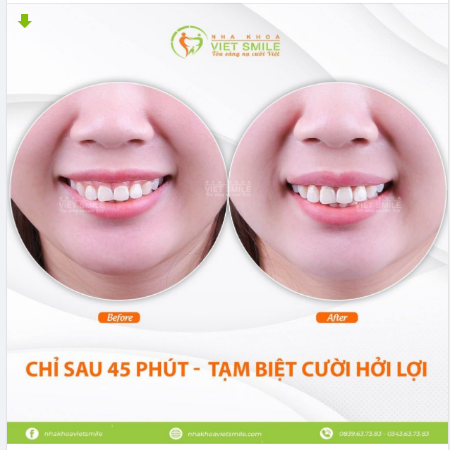 CHỈ 45 PHÚT - TẠM BIỆT CƯỜI HỞ LỢI.