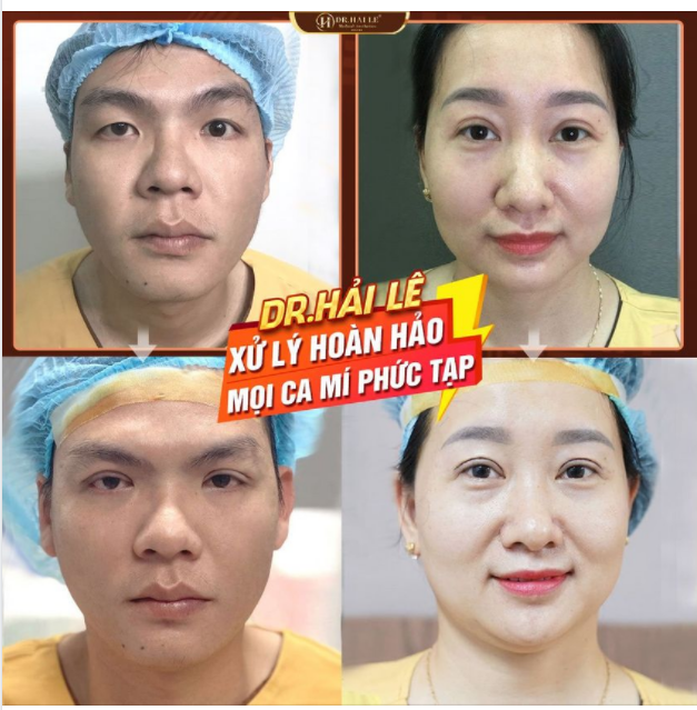 Chỉ 60 phút - Thay đổi 180 độ với với kỹ thuật cắt mí MK tại Dr.Hải Lê.