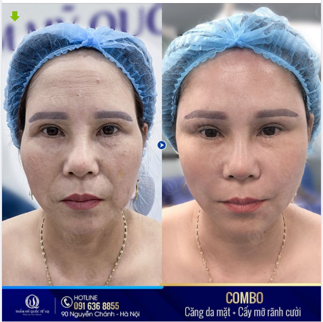 Chị KH đã thật sự hạnh phúc khi Bs Vũ Quang và ekip thực hiện xong combo "Đánh thức tuổi xuân": căng da mặt + cấy mỡ rãnh cười