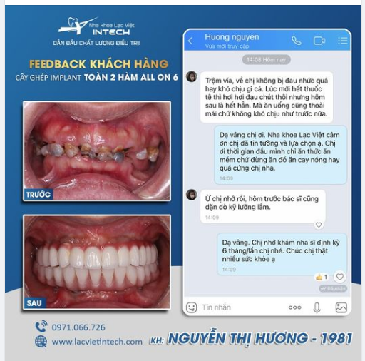Chị Nguyễn Thị Hương (40 tuổi) đã lựa chọn Lạc Việt Intech để khôi phục răng toàn hàm bằng phương pháp  ALL ON 6!