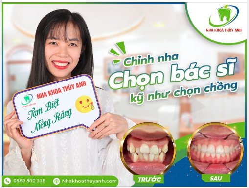 CHI PHÍ NIỀNG RĂNG GIẢM SÂU NHẤT TỪ TRƯỚC ĐẾN NAY CHỈ CÓ TRONG THÁNG 7