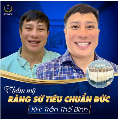 Chỉ sau 2 lần hẹn với công nghệ thẩm mỹ răng sứ tiêu chuẩn Đức, Nha khoa Quốc tế Việt Đức đã giúp Anh Trần Thế Bình “tái sinh” hàm răng xỉn màu, khấp khểnh.
