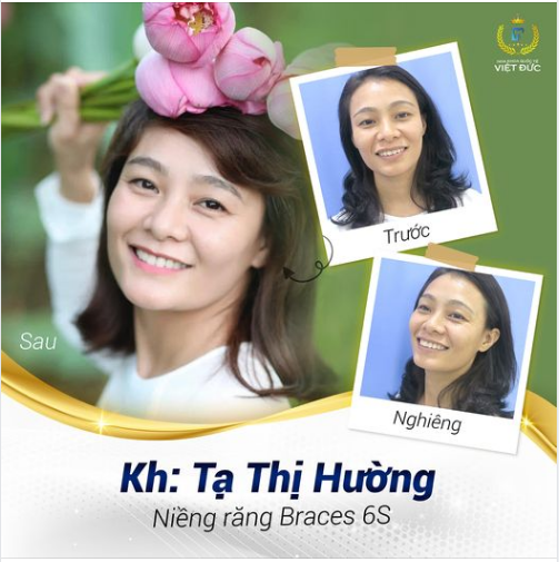 Chị Tạ Thị Hường đã ngoài 30 tuổi nhưng sự tự ti về hàm răng khấp khểnh, gương mặt thiếu cân đối đã thôi thúc chị đến Nha khoa Quốc tế Việt Đức để tư vấn chỉnh nha.