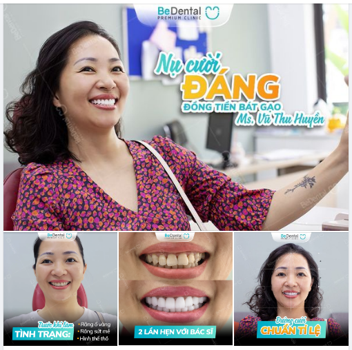 Chị Thu Huyền sau phục hình răng sứ khắc phục răng nhiễm màu Tetracycline tại nha khoa Be