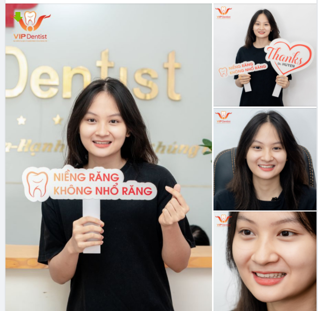Chia sẻ từ bạn Yến Nhi niềng răng 2 năm tại VIP Dentist