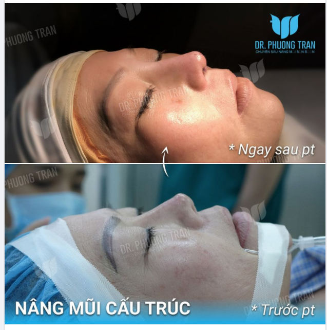 CHIẾC MŨI GỒ GHỀ, LỘ SỐNG CHỈ MONG SỰ “BÌNH THƯỜNG”