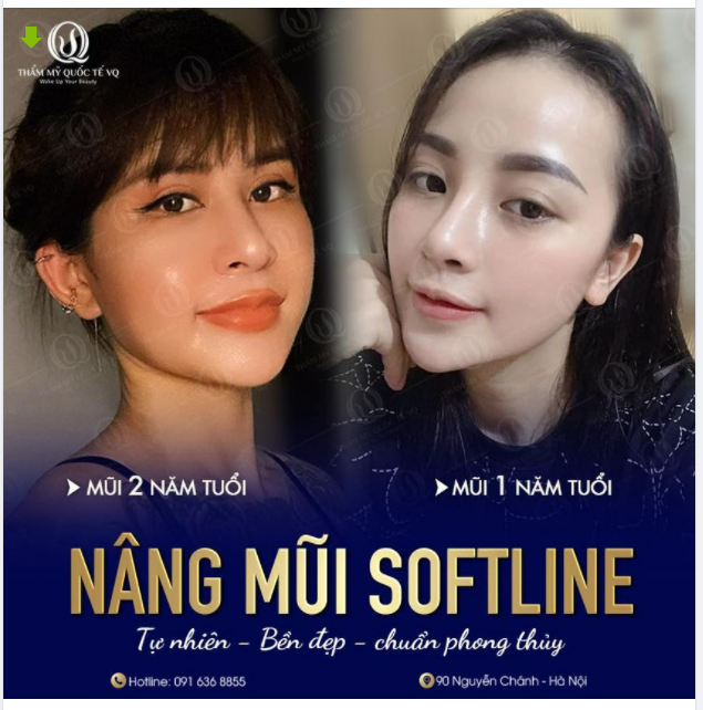 Chiêm ngưỡng kết quả sau các mốc thời gian khác nhau khi nâng mũi Softline