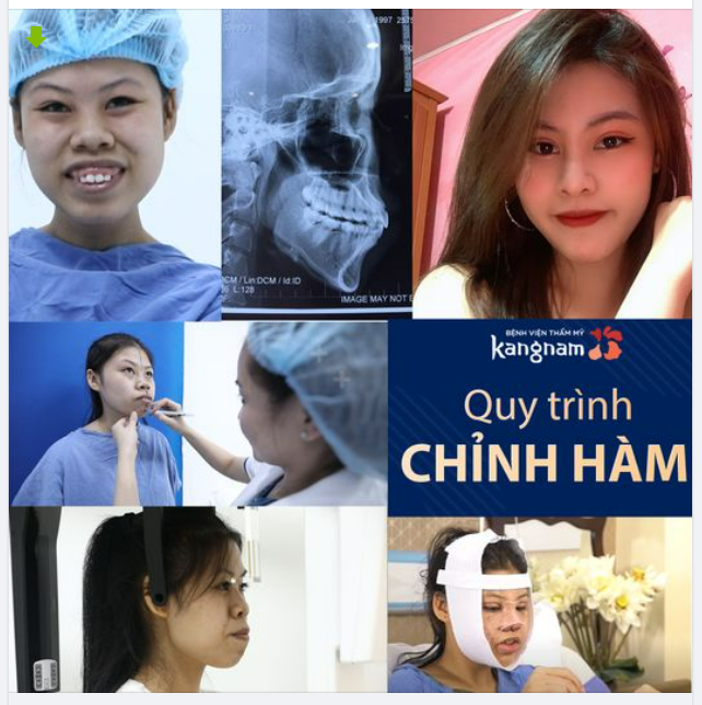 CHÌNH HÀM AN TOÀN, HIỆU QUẢ CẦN ĐẢM BẢO 6 BƯỚC CHUẨN CHỈ SAU