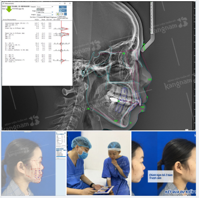 Chỉnh hàm hô 2 hàm + Trượt cằm cho khách hàng hàm hô