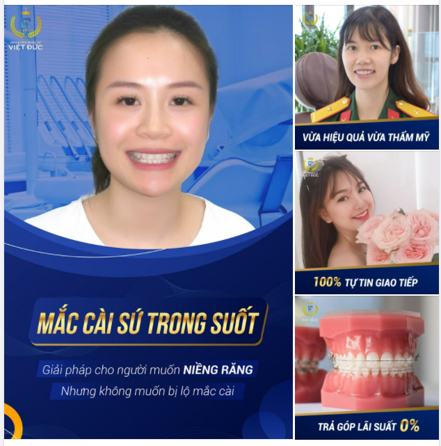 Chỉnh nha mắc cài sứ trong suốt - Thẩm mỹ cao - Tự ton Selfie