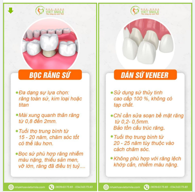 Chọn bọc răng sứ hay dán sứ Veneer
