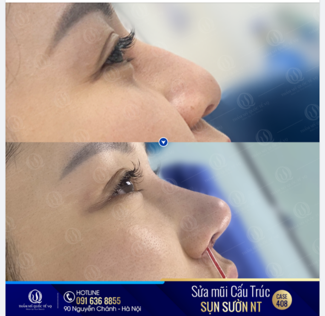 CHỌN ĐỊA CHỈ ĐÚNG KHI MŨI ĐÃ HỎNG QUAN TRỌNG THẾ NÀO?