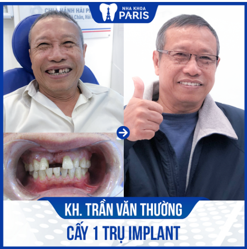 Chú Trần Văn Thường đến với Nha khoa Paris trong tình trạng bị mất 1 răng cửa hàm trên.
