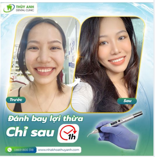CHỮA CƯỜI HỞ LỢI CÔNG NGHỆ LASER ARC CHUẨN ĐỨC ĐẸP NGAY LẬP TỨC
