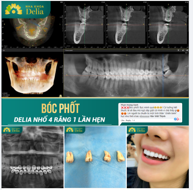 Chuẩn bị tinh thần thép khi tới Delia nhổ luôn 04 răng khôn sau khi đã thẩm mỹ răng sứ, khách hàng “thất vọng” vì chẳng đau như mình tưởng tượng
