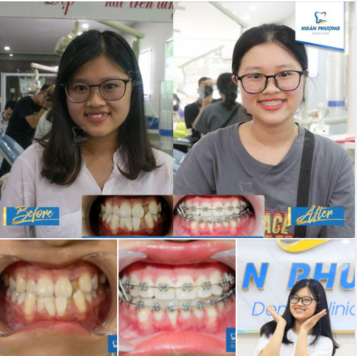 Chúc mừng Thu Trang đã vượt qua giai đoạn khó khăn nhất khi niềng răng.