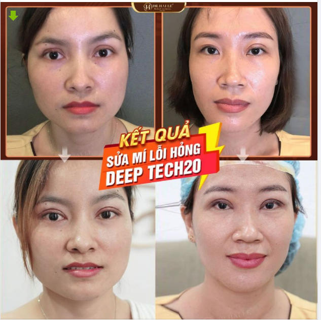 Cơ hội vàng sửa mí DEEP TECH20 với chi phí cực hời tại Dr.Hải Lê