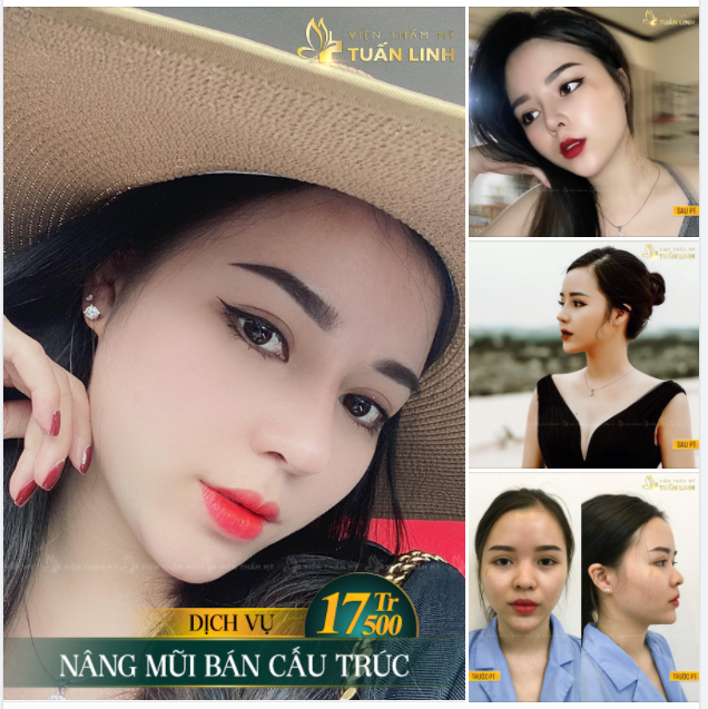 CÔ NÀNG HOTGIRL NÂNG MŨI TẠI TUẤN LINH GỬI FEEDBACK SIÊU XINH CHO BÁC SĨ ĐÂY Ạ: