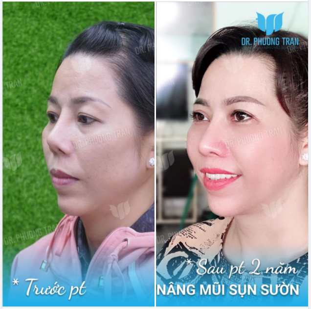 CÓ NÊN CHẠY THEO ĐỘ CAO KHI NÂNG MŨI?