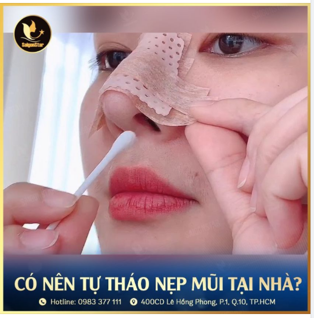 CÓ NÊN THÁO NẸP MŨI TẠI NHÀ KHÔNG?