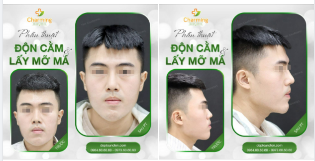 Có những phẫu thuật tuy nhỏ nhưng mang đến những thay đổi rất lớn. Điển hình như phẫu thuật độn cằm và lấy túi mỡ má mà chàng khách đã thực hiện cùng Charming đây.
