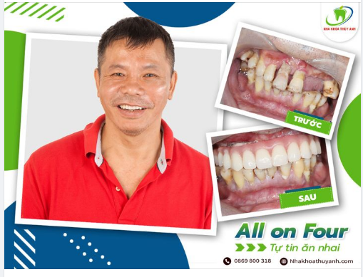 CÓ RĂNG ĂN NHAI CHỈ SAU 48H VỚI ALL ON 4