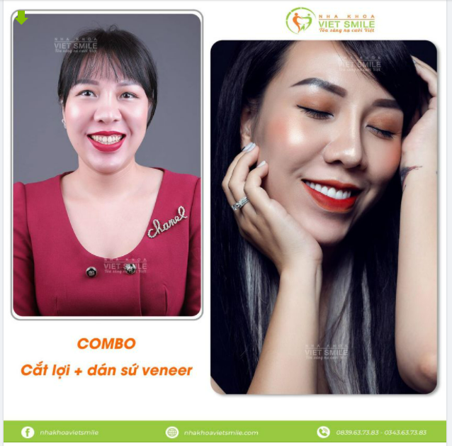 COMBO CẮT LỢI + DÁN SỨ - CÔNG THỨC CHO MỘT NỤ CƯỜI HOÀN HẢO