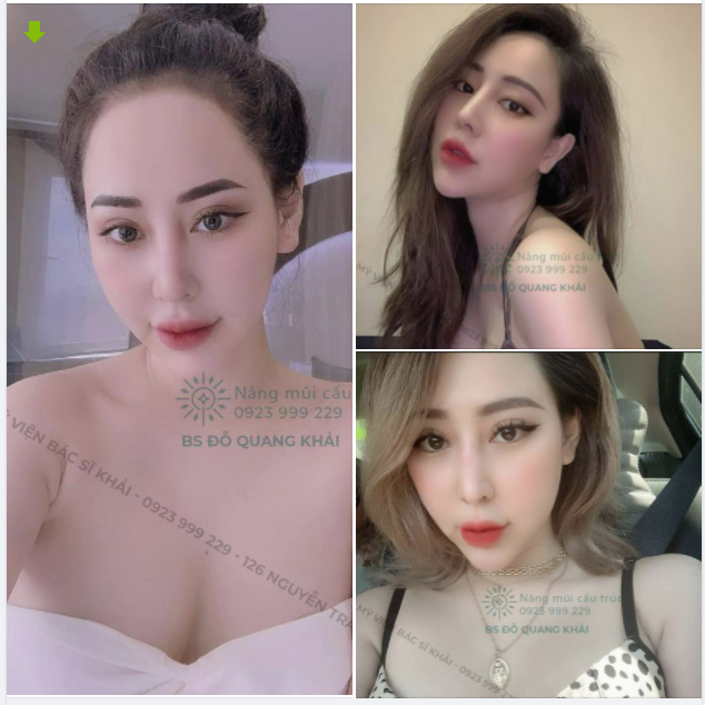 COMBO CẮT MÍ ẤN ĐỘ - NÂNG MŨI CẤU TRÚC SAU 2 NĂM