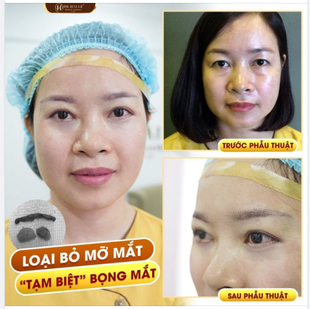 Combo Cắt mí dưới Nâng cung mày - Giải pháp cải thiện những khuyết điểm của đôi mắt