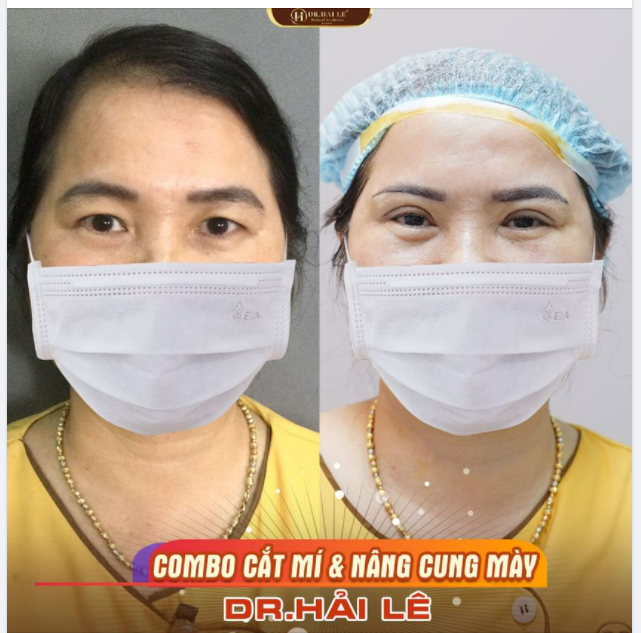 Combo Cắt mí + Nâng cung mày "Biến hình" đôi mắt là có thật