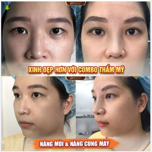 Combo Nâng mũi Nâng cung mày KH xinh đẹp hơn là động lực to lớn của Dr.Hải Lê