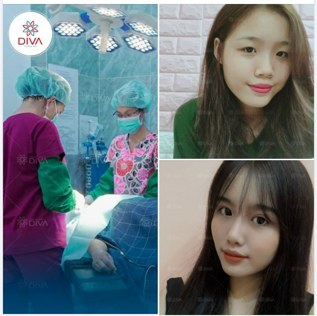 COMBO NÂNG MŨI + NHẤN MÍ MẮT: GƯƠNG MẶT XINH ĐẸP, THẦN THÁI SANG CHẢNH
