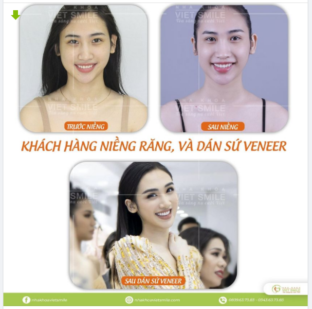 Combo niềng răng Invisalign dán sứ Veneer chính là công thức tạo nên một nụ cười hoàn hảo cho khách hàng khi đến với Việt Smile.