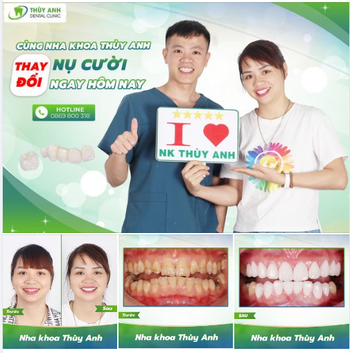 CÙNG NHA KHOA THÙY ANH THAY ĐỔI NỤ CƯỜI NGAY HÔM NAY