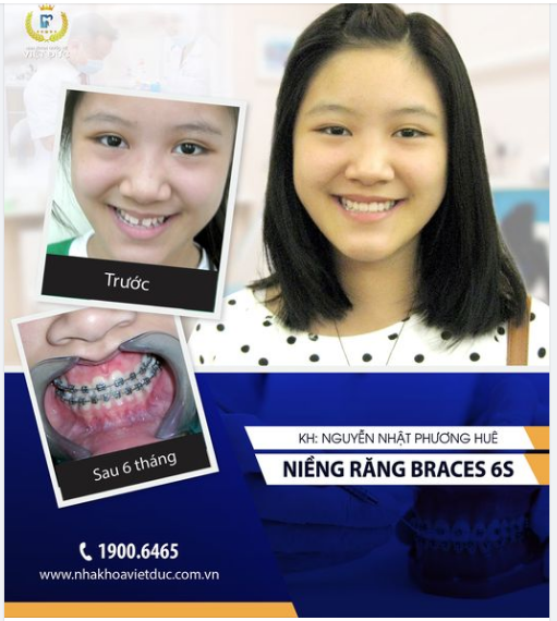 CƯỜI TỰ TIN - RĂNG XINH RẠNG RỠ