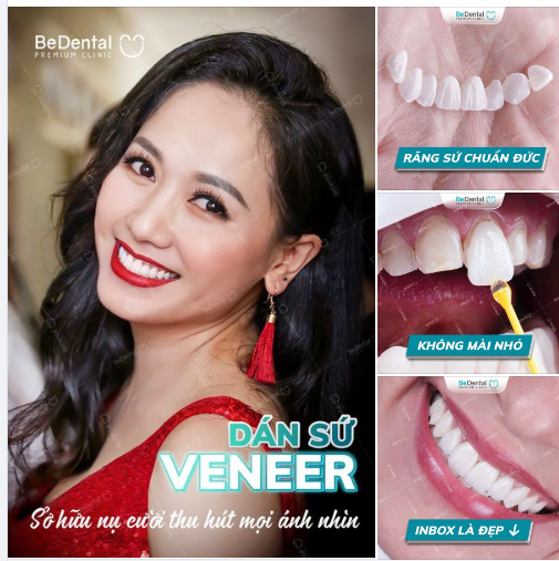 "Cứu nguy" mọi khuyết điểm răng với dán sứ Veneer