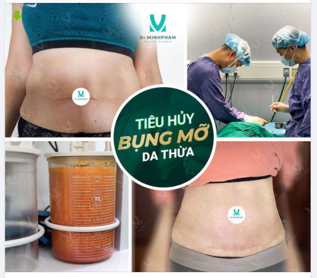DA TRÙNG – MỠ THỪA CHỈ LÀ CHUYỆN NHỎ Với combo “HÚT MỠ TẠO HÌNH THÀNH BỤNG”