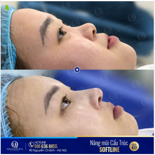 Đắn đo bao tháng ngày, sau 40p nhìn ngắm dáng mũi mới đẹp như ý chỉ trách mình "sao không gặp Bs Vũ Quang sớm hơn"