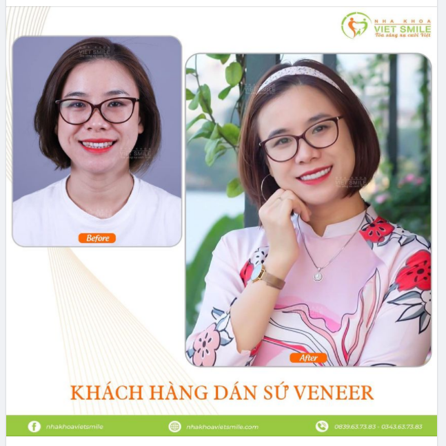 Dán sứ Veneer khắc phục tình trạng răng không đều màu.